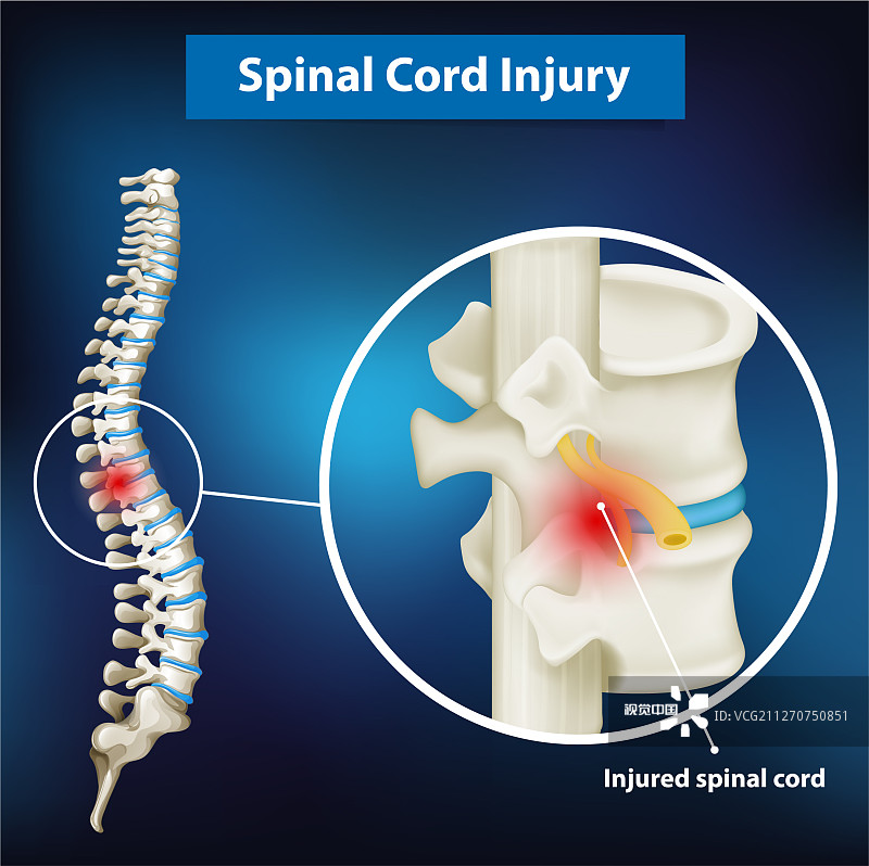 間充質干細胞治療脊髓損傷的臨床應用