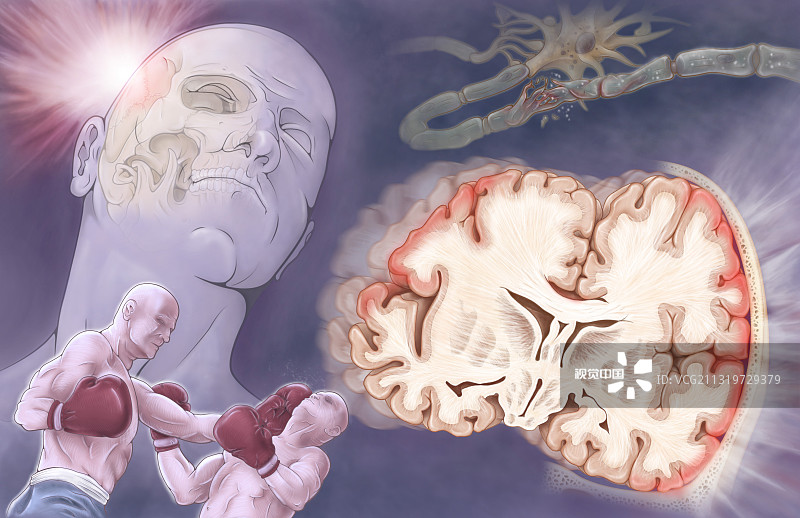 間充質干細胞治療創傷性腦損傷的臨床進展