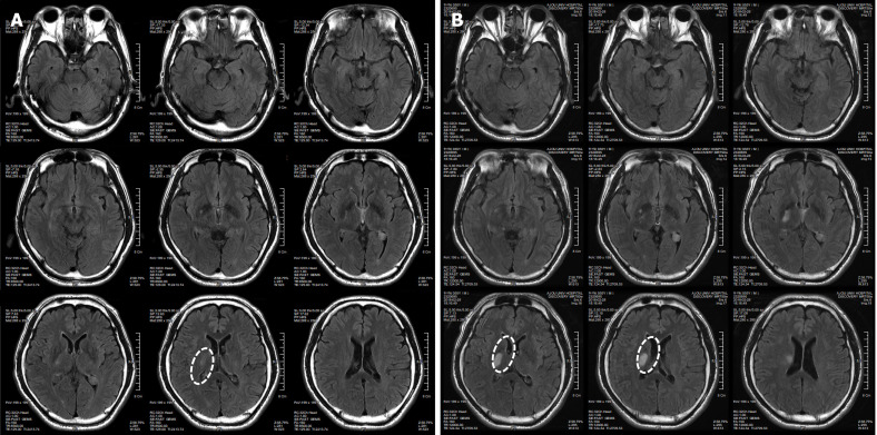圖1：微創(chuàng)人臍帶間充質(zhì)干細(xì)胞移植前患者的腦部計(jì)算機(jī)斷層掃描圖像。