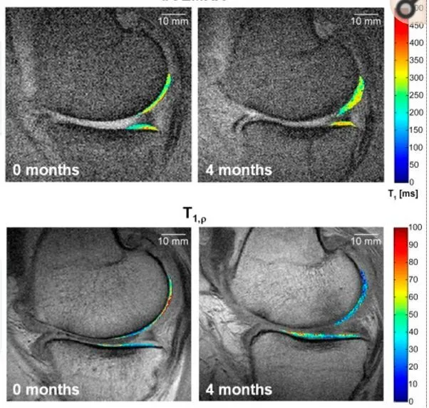干細胞療法修復后疼痛顯著減輕，半月板軟骨質(zhì)量提高。