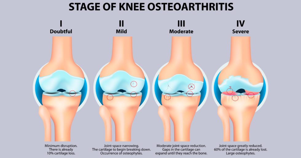 骨關節炎癥狀有哪些 骨關節炎癥狀有哪些