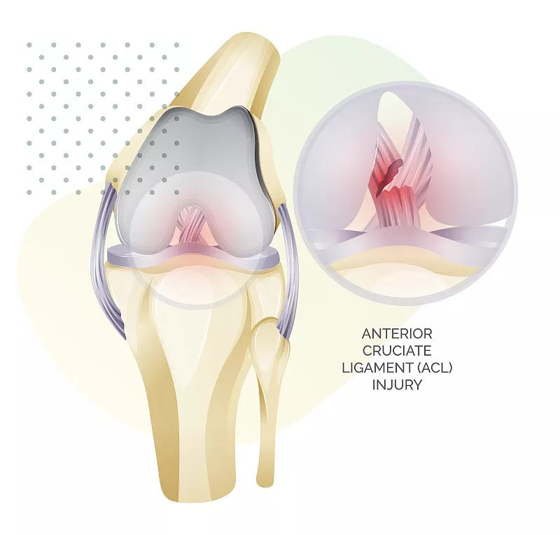 干細(xì)胞療法對(duì)半月板損傷的益處 干細(xì)胞療法對(duì)半月板損傷的益處