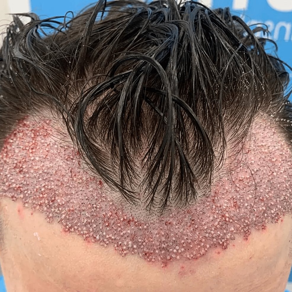 頭發(fā)移植手術(shù)后即刻的結(jié)果?！@允許在患者中建立更豐滿和更前的發(fā)際線