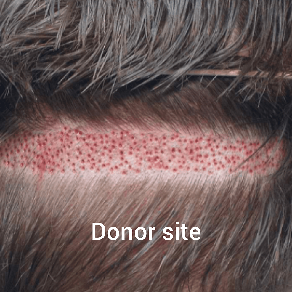 新技術(shù)的供體現(xiàn)場(chǎng)收獲試圖減少后部頭皮疤痕