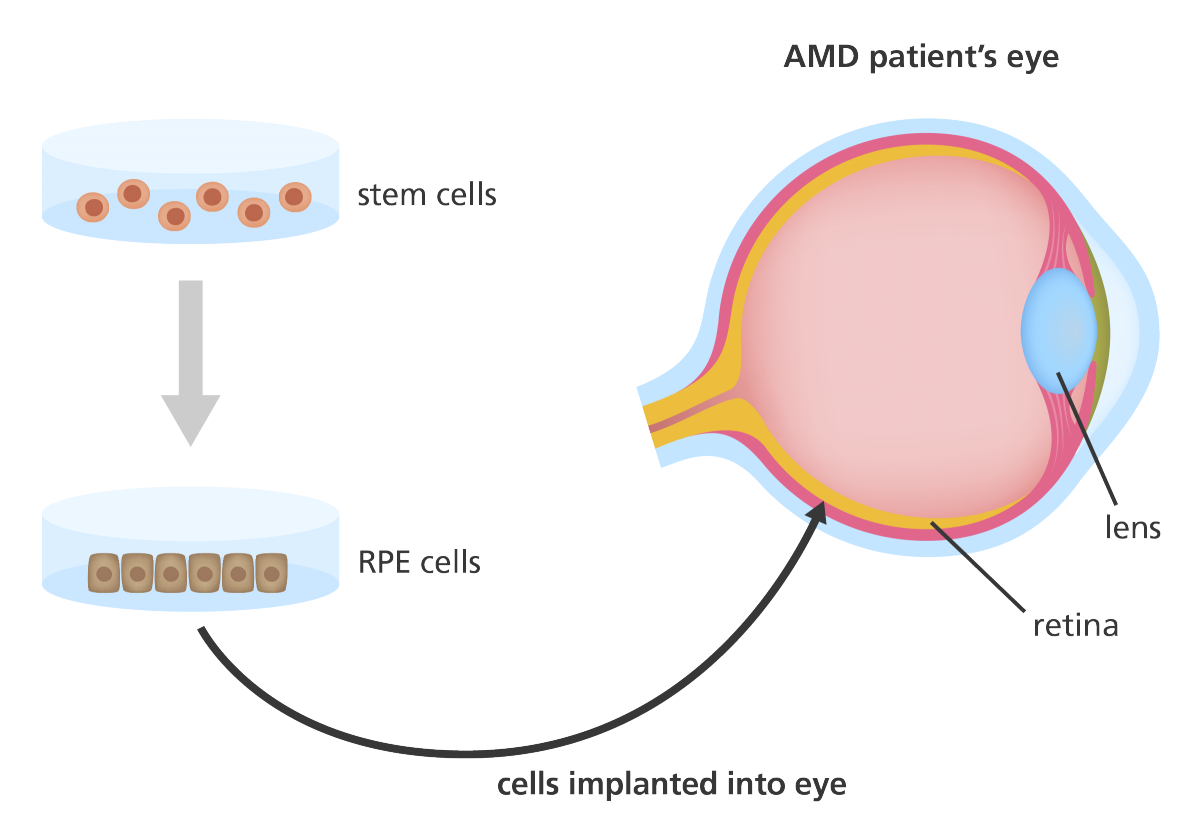插圖顯示干細胞如何用于產生可用于治療年齡相關性黃斑變性 (AMD) 患者的視網膜色素上皮 (RPE) 細胞