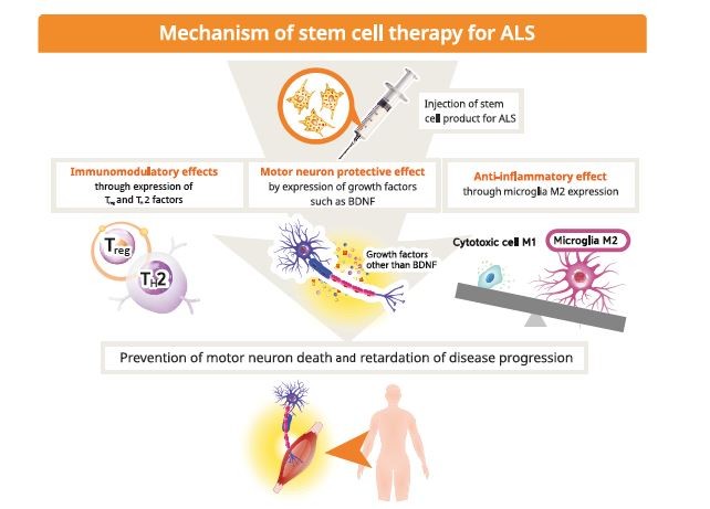 干細胞療法用于治療肌萎縮側索硬化癥（ALS）。