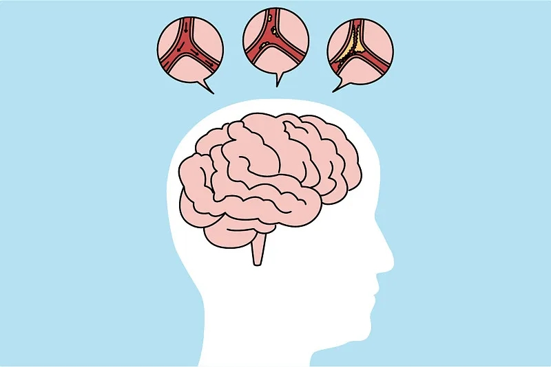 通過比較6、12、24個(gè)月的結(jié)果，來(lái)評(píng)估干細(xì)胞治療缺血性中風(fēng)的有效性和安全性