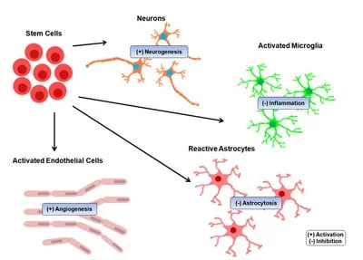 干細胞治療中風的結果 干細胞治療中風的結果