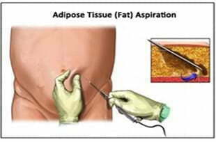 從脂肪中分離干細胞脂肪 從脂肪中分離干細胞脂肪