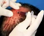 毛囊周圍 毛囊周圍