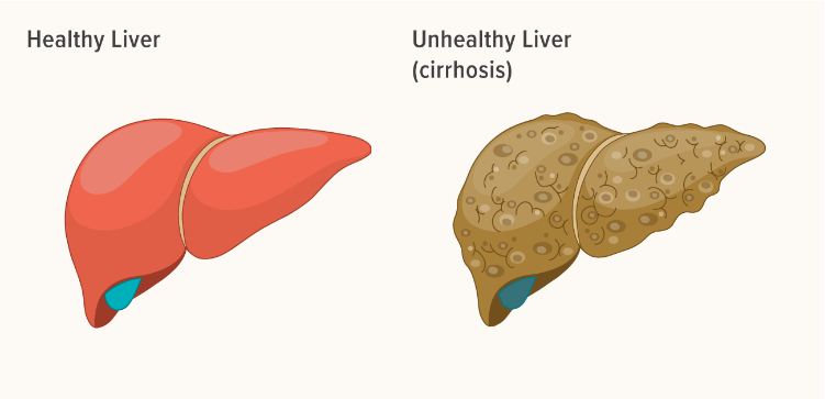 導致肝臟疾病的問題及其原因 導致肝臟疾病的問題及其原因