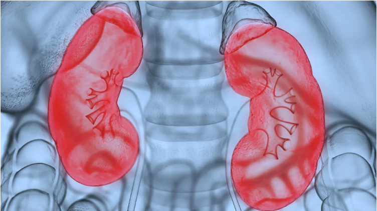 什么是腎病綜合征？癥狀和治療