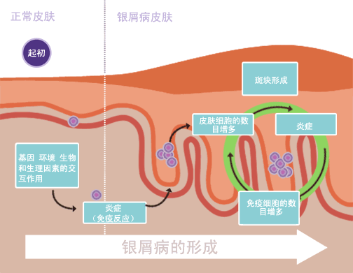 銀屑病治愈:是科學事實還是虛假希望? 銀屑病治愈:是科學事實還是虛假希望?