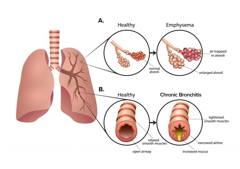 圖2:慢性阻塞性肺疾病 (COPD) 是一組導致呼吸困難的肺部疾病。A. 肺氣腫導致肺泡氣囊受損和僵硬。空氣被困在肺泡中,導致呼氣困難。B. 慢性支氣管炎會導致氣道腫脹和粘液增多。多余的粘液使呼吸困難并導致慢性咳嗽 圖2:慢性阻塞性肺疾病 (COPD) 是一組導致呼吸困難的肺部疾病。A.肺氣腫導致肺泡氣囊受損和僵硬。空氣被困在肺泡中,導致呼氣困難。B.慢性支氣管炎會導致氣道腫脹和粘液增多。多余的粘液使呼吸困難并導致慢性咳嗽