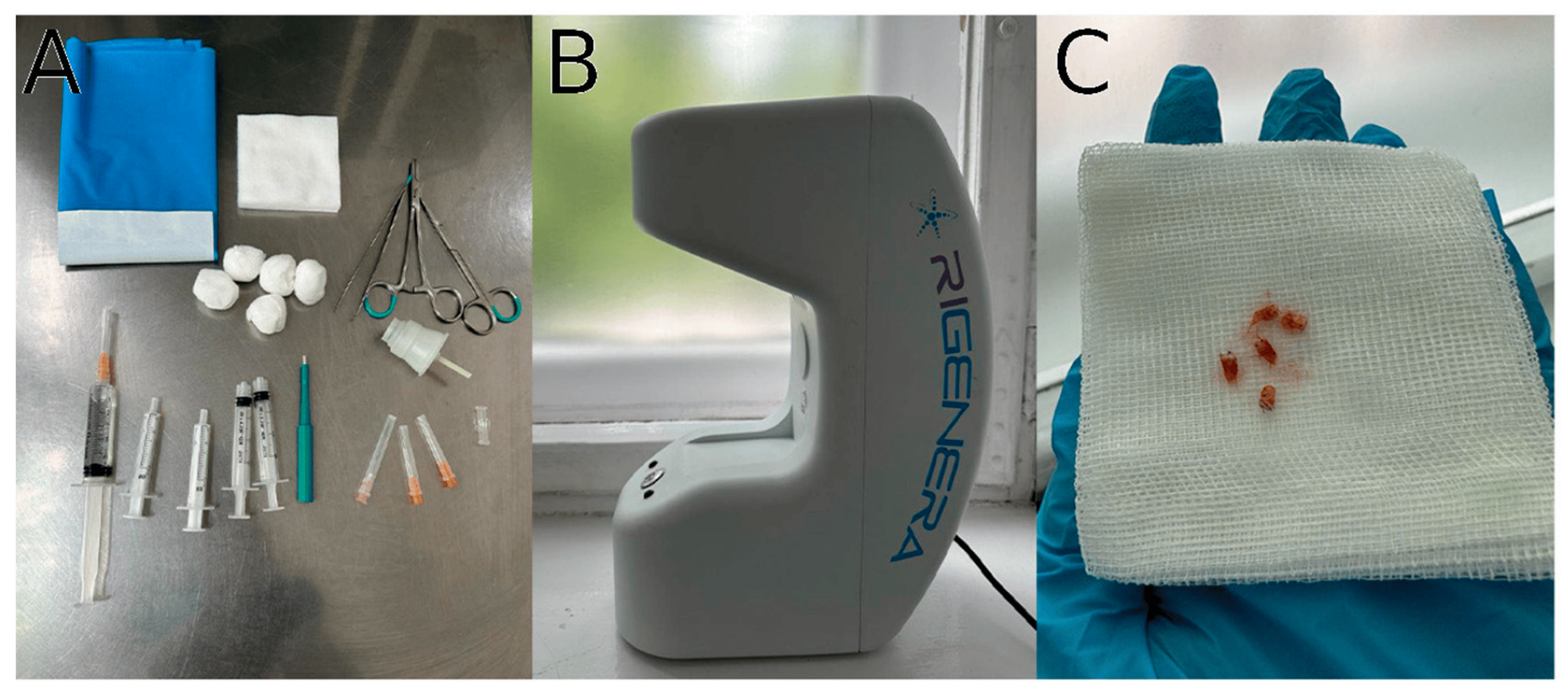 圖1：自體細(xì)胞微移植治療方案要素。