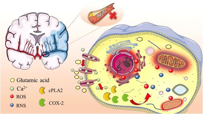 高血壓、高脂血癥、高同型半胱氨酸血癥、高血糖、吸煙和酗酒等危險因素都可能引發缺血性中風的發生。 高血壓、高脂血癥、高同型半胱氨酸血癥、高血糖、吸煙和酗酒等危險因素都可能引發缺血性中風的發生。