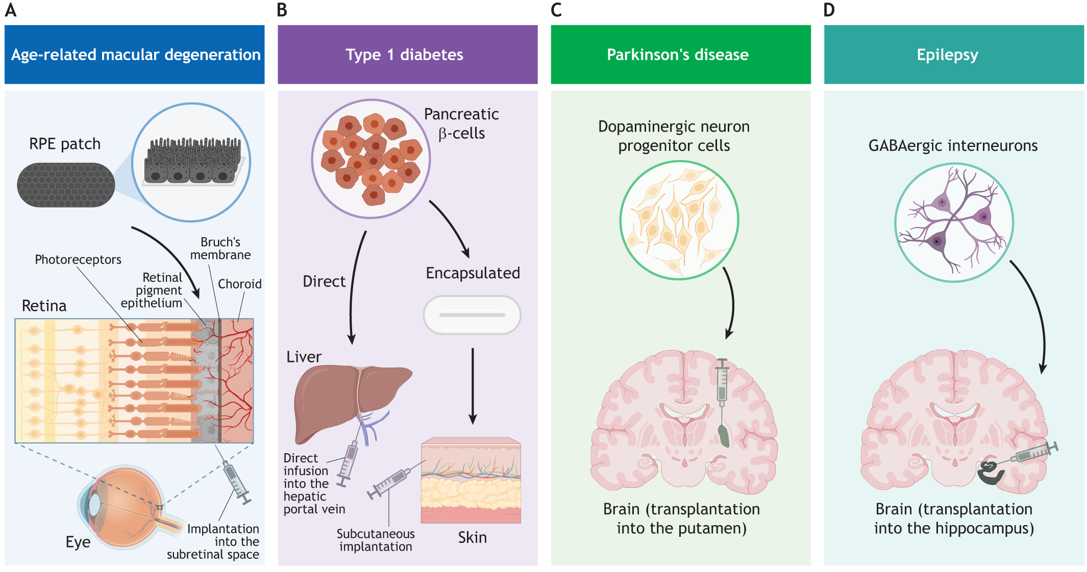 圖2:使用hPSC衍生細胞產(chǎn)品進行開創(chuàng)性臨床試驗時所涉及的細胞類型和注射部位的圖示。 圖2:使用hPSC衍生細胞產(chǎn)品進行開創(chuàng)性臨床試驗時所涉及的細胞類型和注射部位的圖示。