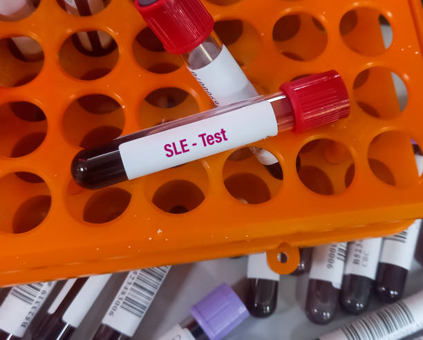 干細胞移植治療系統性紅斑狼瘡的臨床療效分析 干細胞移植治療系統性紅斑狼瘡的臨床療效分析