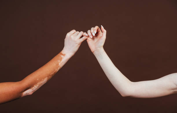 干細胞轉換醫學雜志:干細胞治療難治性白癜風安全有效 干細胞轉換醫學雜志:干細胞治療難治性白癜風安全有效