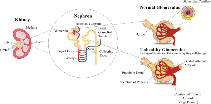 圖1：導致糖尿病腎病的原因，即糖尿病引起的腎臟疾病