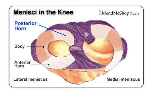 后角半月板撕裂癥狀、原因以及治療方法