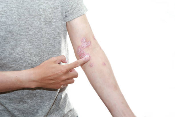 預防銀屑病發作的10個技巧，你都了解嗎？