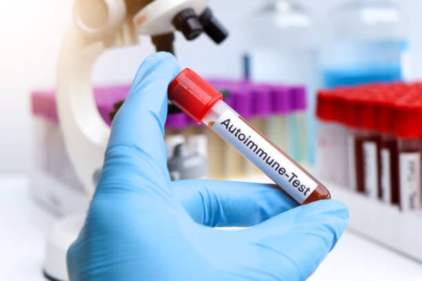 干細胞在類風(fēng)濕關(guān)節(jié)炎、系統(tǒng)性紅斑狼瘡、銀屑病等自身免疫性疾病中的治療作用