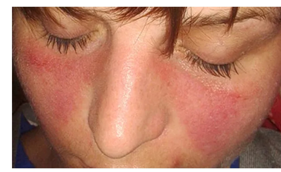 系統(tǒng)性紅斑狼瘡癥狀、病因和治療方法