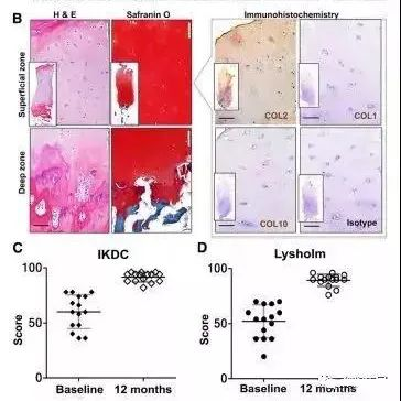 干細胞治療膝骨關節炎臨床案例