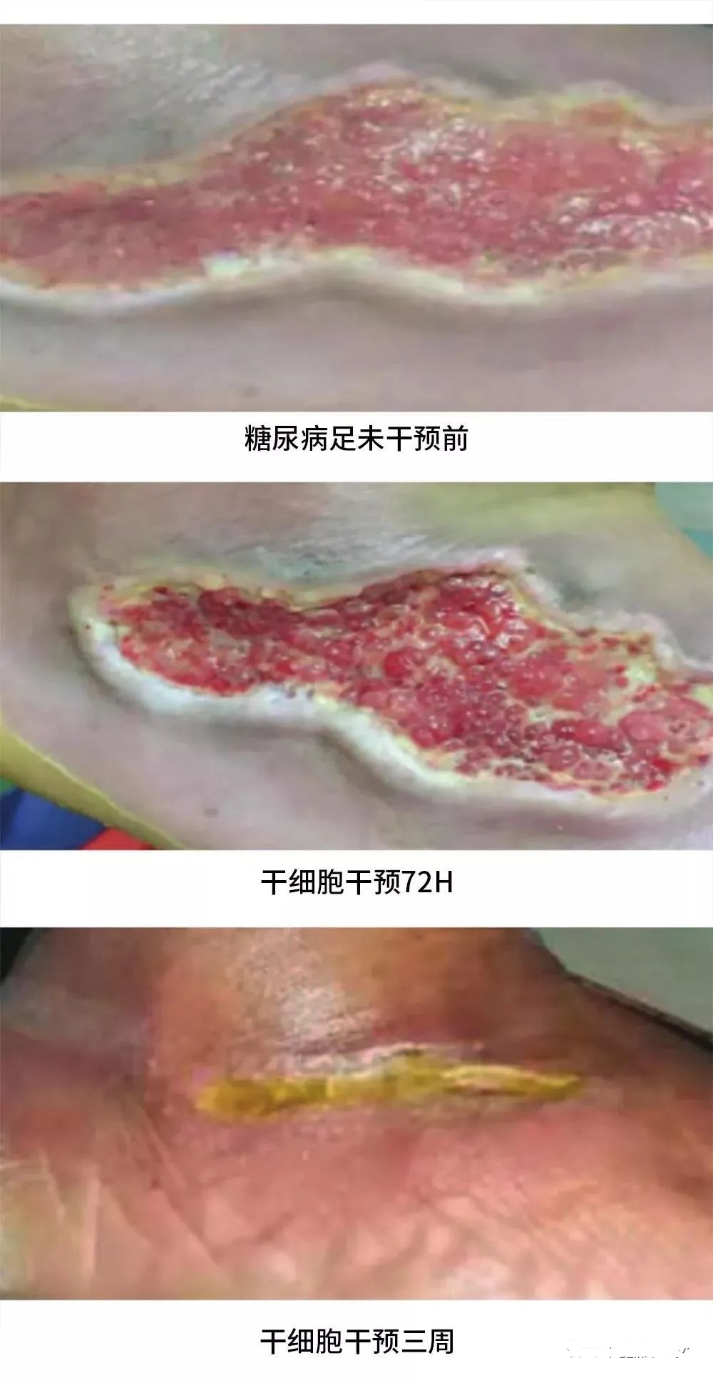 患者治療72小時化膿性分泌物和傷口大小明顯減少，3周后足部潰瘍幾乎愈合，足部行走功能也得到了恢復。