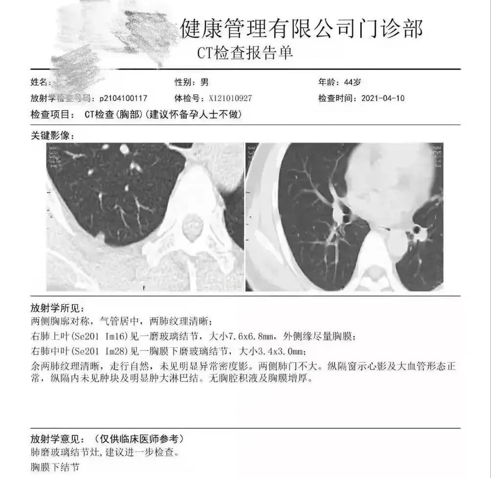 結果發(fā)現(xiàn)王先生右肺胸膜表面下（肺的內(nèi)部），存在兩枚磨玻璃結節(jié)，其中較大者直徑7.6mm。