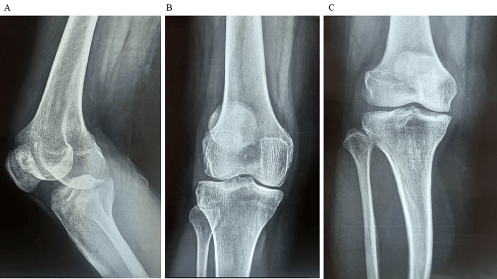 圖1：顯示了開始干細(xì)胞治療之前的骨骼側(cè)視圖和前后視圖。