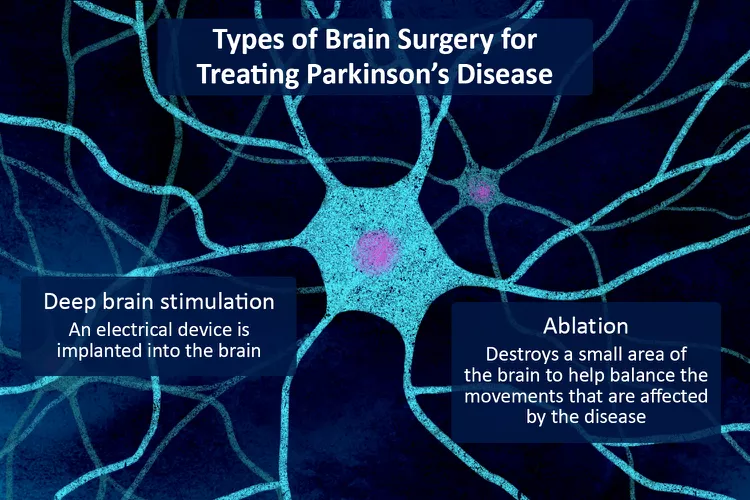 帕金森病的腦部手術:類型、恢復和風險 帕金森病的腦部手術:類型、恢復和風險