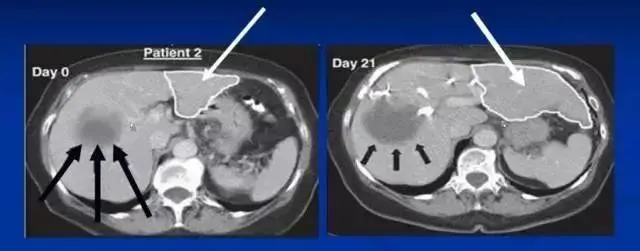 干細(xì)胞治療肝硬化的治療效果如何？
