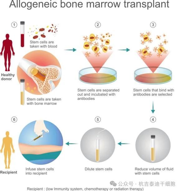 干細(xì)胞移植治療需要多長(zhǎng)時(shí)間? 干細(xì)胞移植治療需要多長(zhǎng)時(shí)間?