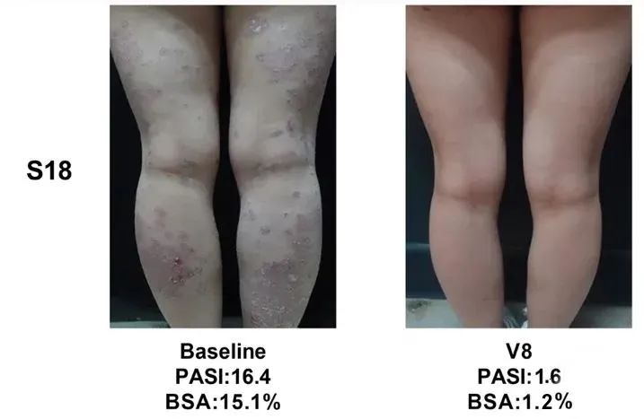 總共47.1% (8/17)的銀屑病患者在PASI(皮損面積和嚴(yán)重程度)評分中有至少40%的改善 總共47.1% (8/17)的銀屑病患者在PASI(皮損面積和嚴(yán)重程度)評分中有至少40%的改善