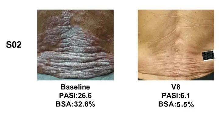 總共47.1% (8/17)的銀屑病患者在PASI(皮損面積和嚴(yán)重程度)評分中有至少40%的改善 總共47.1% (8/17)的銀屑病患者在PASI(皮損面積和嚴(yán)重程度)評分中有至少40%的改善