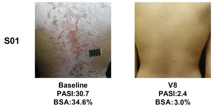 總共47.1% (8/17)的銀屑病患者在PASI(皮損面積和嚴(yán)重程度)評分中有至少40%的改善 總共47.1% (8/17)的銀屑病患者在PASI(皮損面積和嚴(yán)重程度)評分中有至少40%的改善
