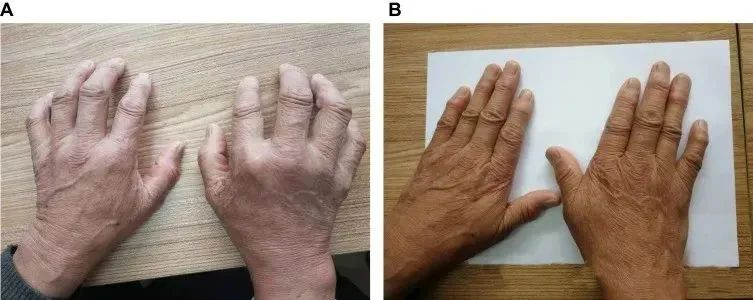 一名68歲男性被診斷患有類(lèi)風(fēng)濕性關(guān)節(jié)炎治療前后的對(duì)比 