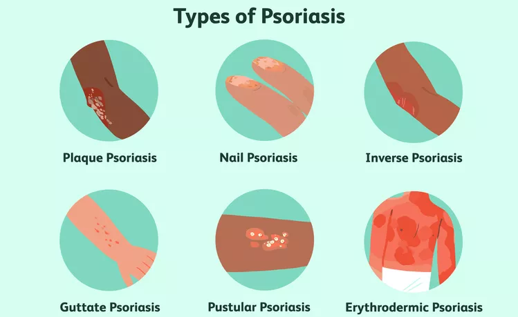 盤點國內各大醫院運用干細胞治療銀屑病的臨床應用