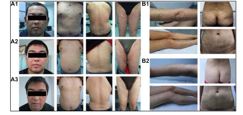 兩例尋常型銀屑病患者通過臍帶間充質干細胞（UC-MSCs）治療，兩例患者均在4至5年內未復發。