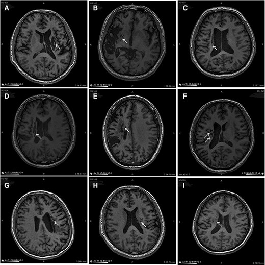 圖3：NSI-566移植后最新隨訪時梗塞部位的MRI。