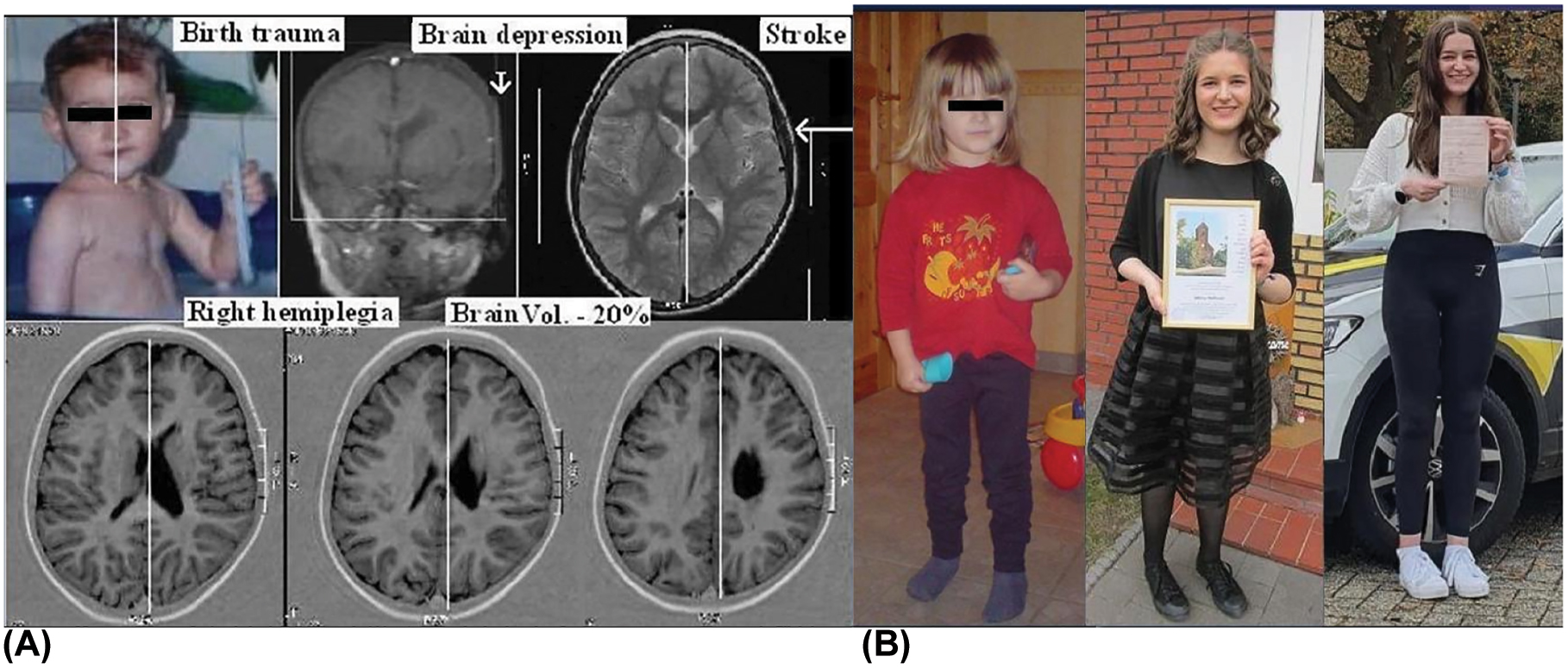 創傷是先天性腦癱的危險因素