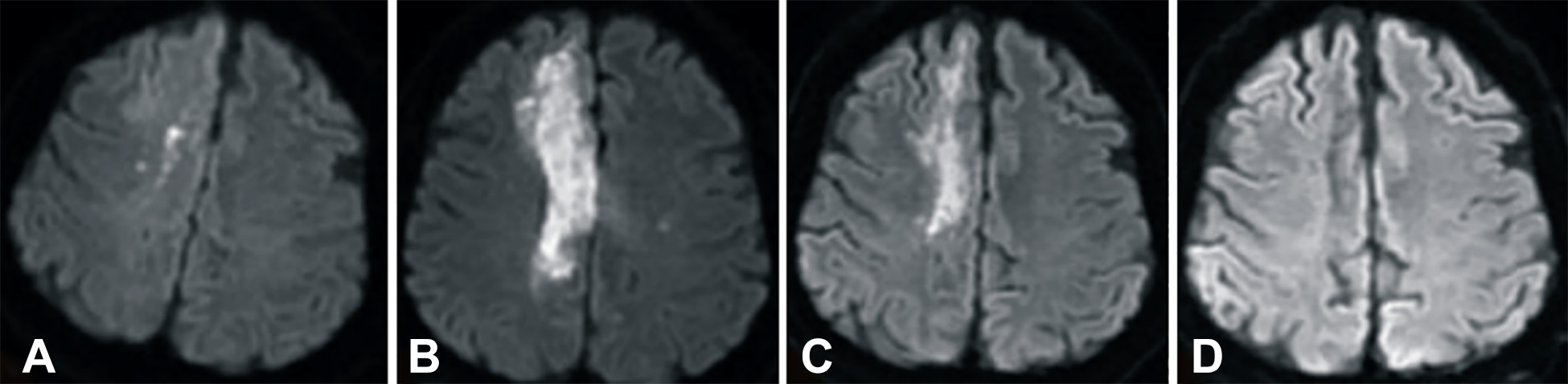 卒中發(fā)病后2小時和單核細胞臍帶血輸注后6個月獲得的彌散加權(quán)圖像