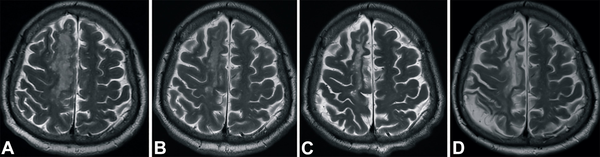 中風(fēng)后2小時和輸血后6個月獲得的T2加權(quán)圖像。