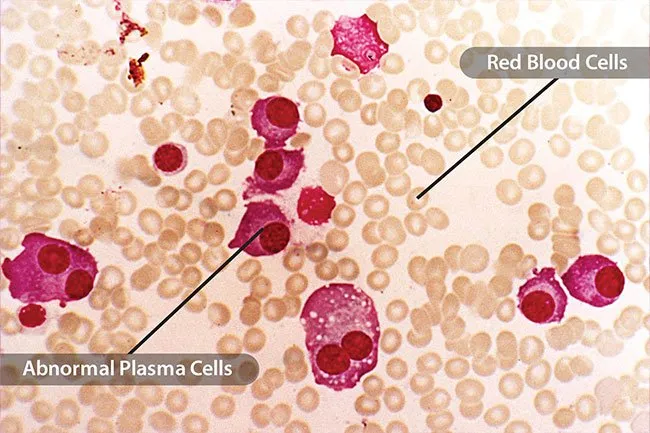 多發性骨髓瘤 多發性骨髓瘤