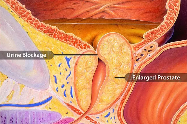 尿路堵塞 尿路堵塞