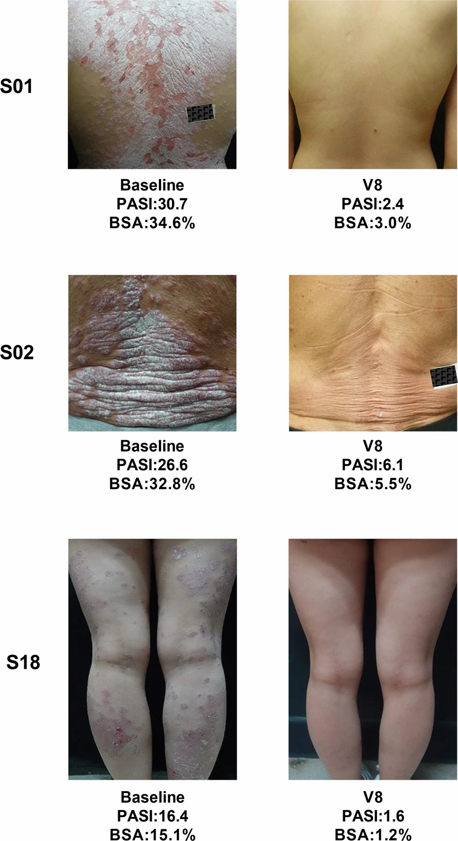 三名患者經過治療后根據 PGA 評分顯示無疾病跡象（評分為 0）或輕微疾病（評分為 1）。
