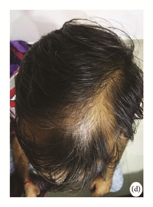 局部應用骨髓間充質干細胞一個月后，銀屑病消退，炎性紅斑完全清除（d）。