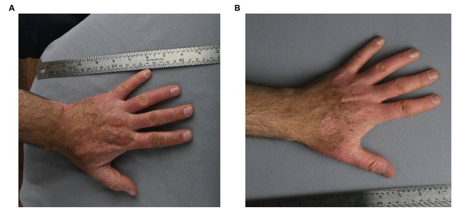 患者3細胞移植6個月后，注射部位的紅斑、脫屑和厚度明顯減少。皮膚厚度從2.1毫米減少到1.7毫米，與手部健康部位相似。該患者報告生活質量有所提高。PASI評分在注射細胞后從4.7變為4.3。